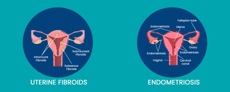 Endometriosis vs Fibroids: Know The Difference