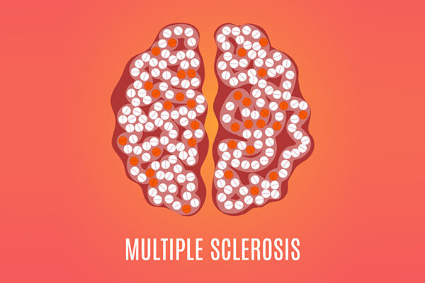 Multiple Sclerosis Quiz