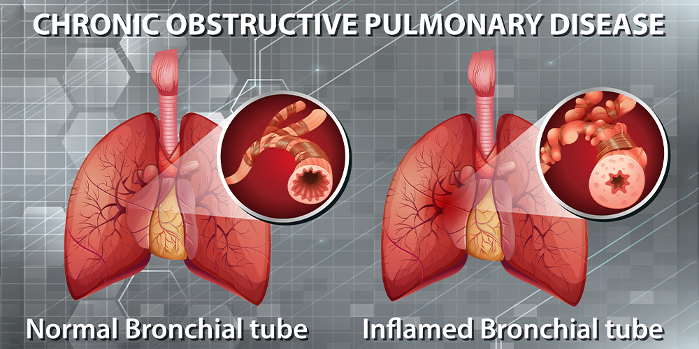 How COPD Affects Pulmonary Parenchyma