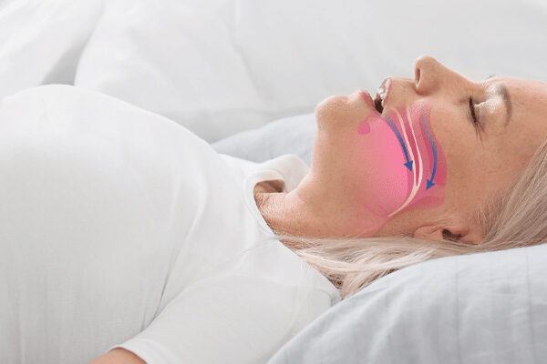 Does sleep apnea cause weight gain?