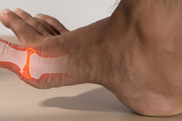What Causes High Uric Acid in the Body